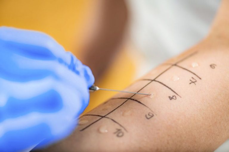 Tes Alergi Kulit: Skin Prick Test dan Patch Test - Emra Clinic